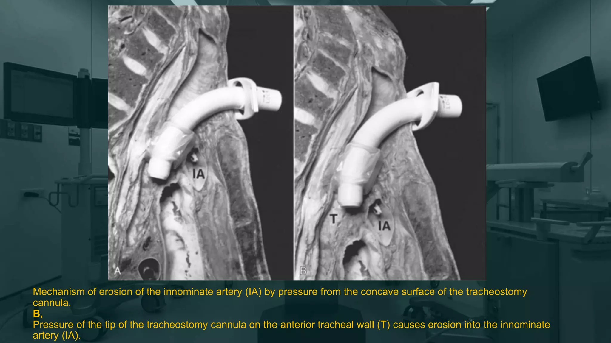 Mechanism of erosion of the innominate artery (IA) by pressure from the concave surface of the tracheostomy
cannula.
B,
Pressure of the tip of the tracheostomy cannula on the anterior tracheal wall (T) causes erosion into the innominate
artery (IA).
 