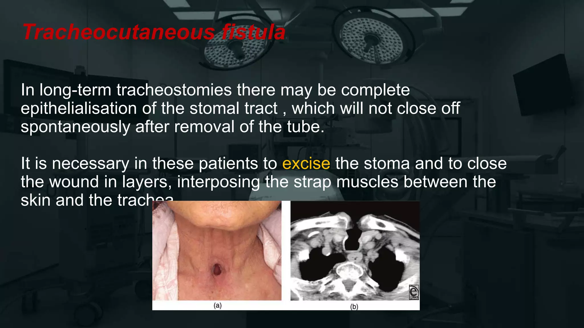 Tracheocutaneous fistula
In long-term tracheostomies there may be complete
epithelialisation of the stomal tract , which will not close off
spontaneously after removal of the tube.
It is necessary in these patients to excise the stoma and to close
the wound in layers, interposing the strap muscles between the
skin and the trachea.
 