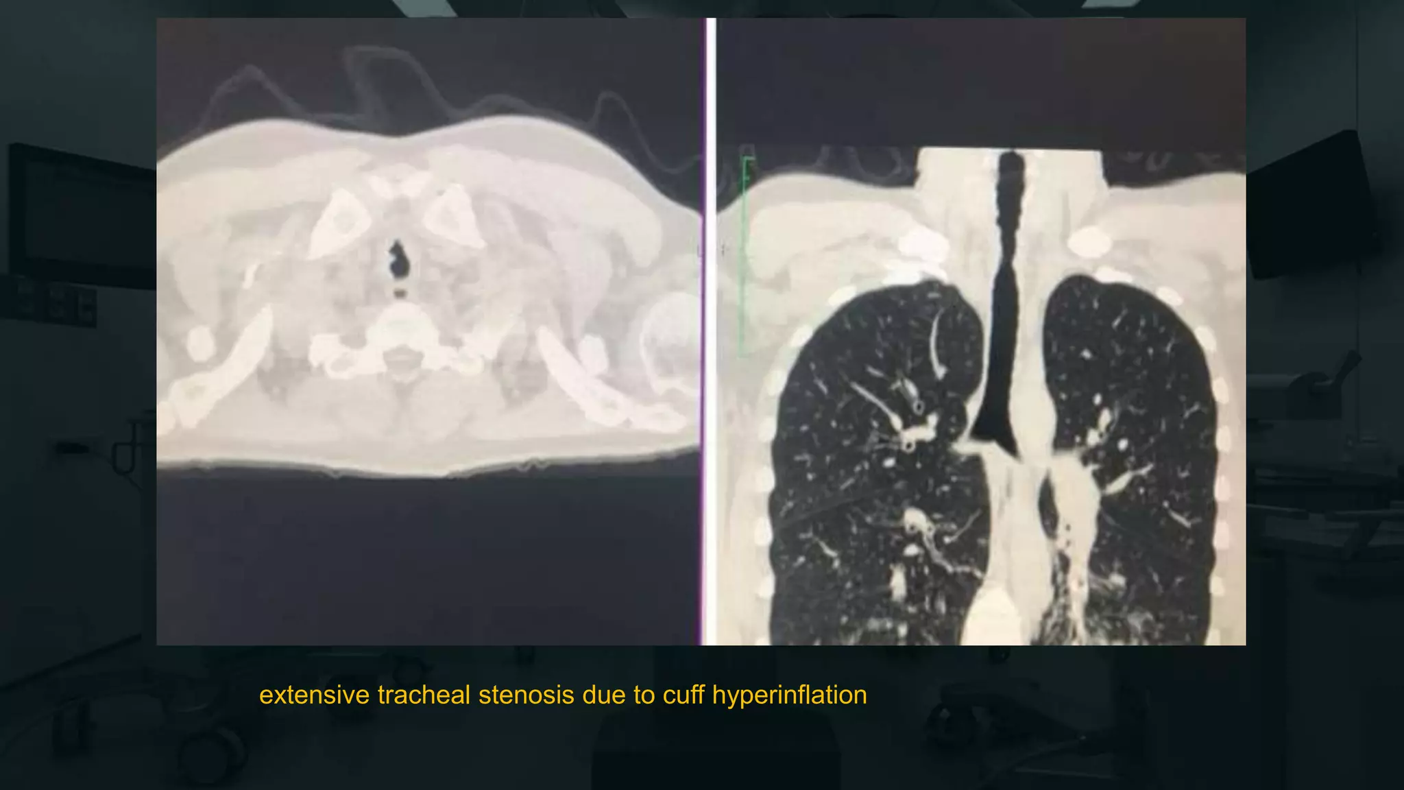 extensive tracheal stenosis due to cuff hyperinflation
 