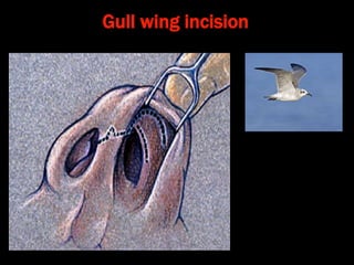 Gullwing Incision Rhinoplasty Principles of rhinoplasty | PPT