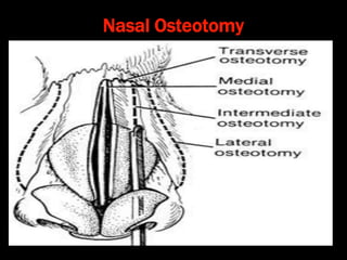 Principles of rhinoplasty | PPT