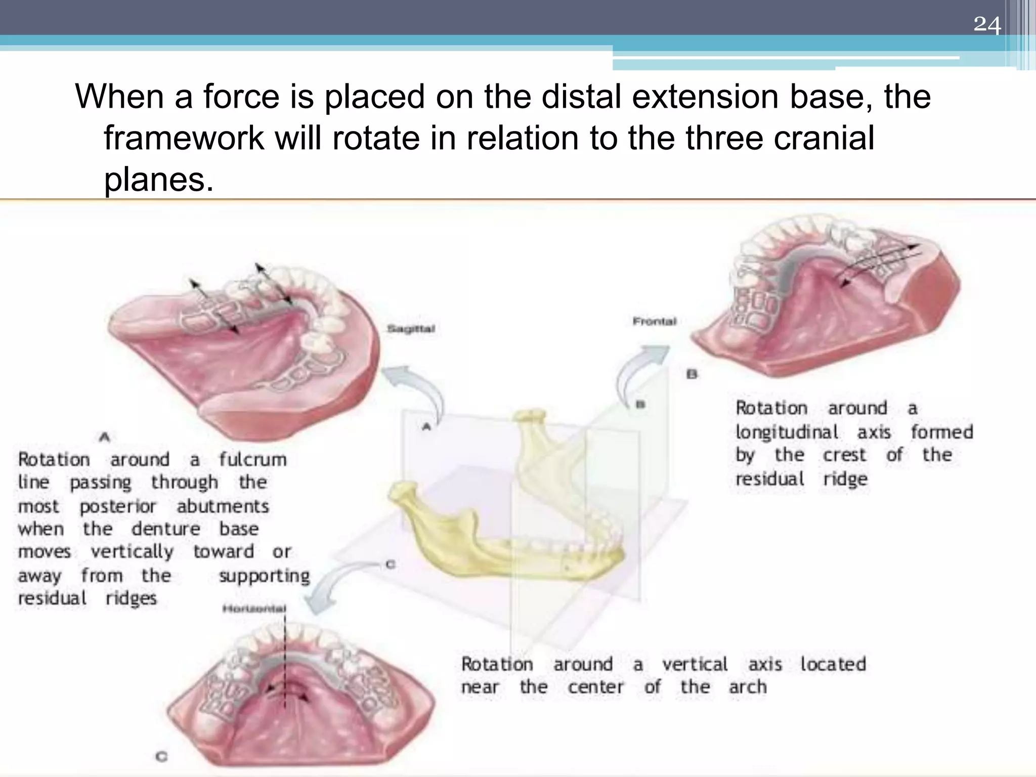 Principles of rpd design according to KENNEDY classification | PPTX