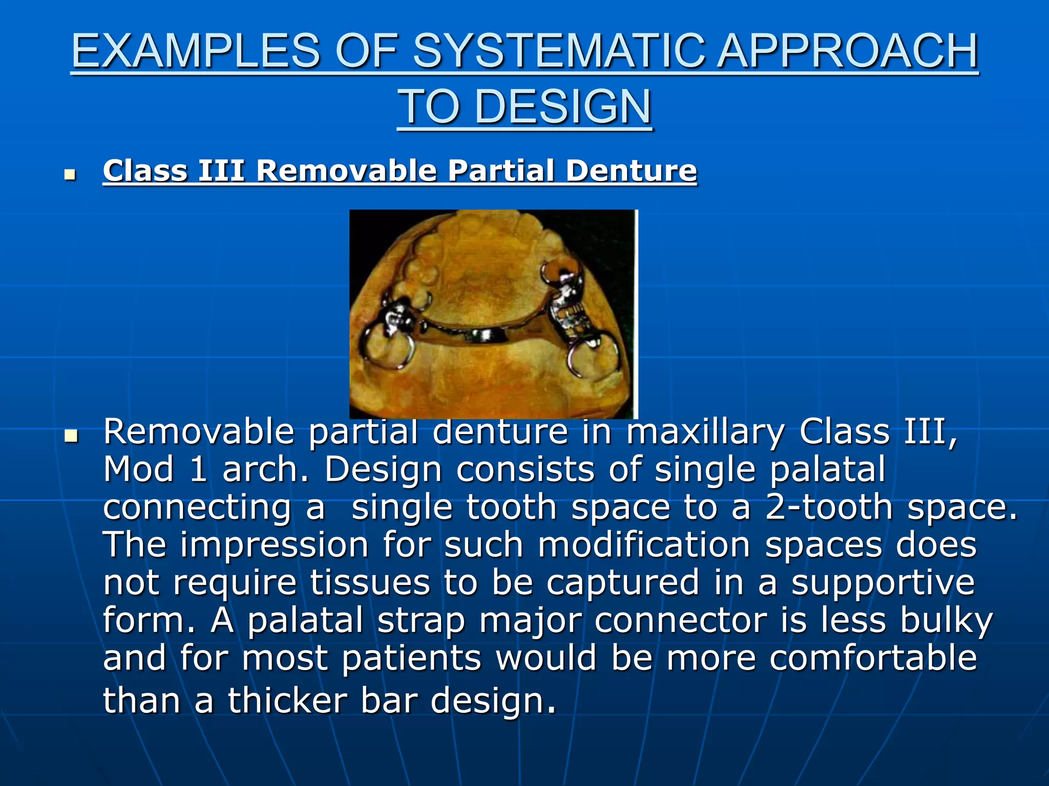 Principles of rpd design | PPT