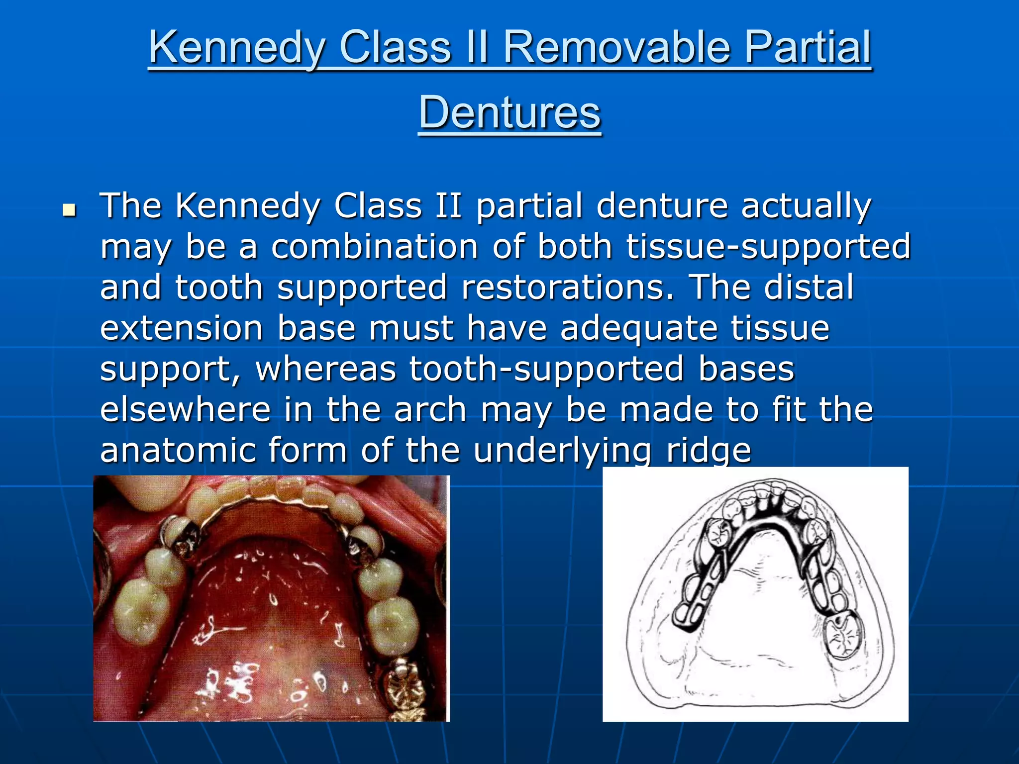 Principles of rpd design | PPT