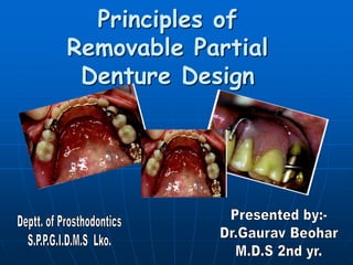 Principles of
Removable Partial
Denture Design
 