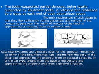 G Clasp Rpd Principles of rpd design | PPT