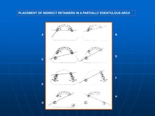 Indirect Retention In Rpd Principles of rpd design | PPT