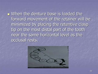 Lever System Rpd principles of rpd design.ppt