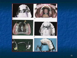 principles off removable partial denture | PPT