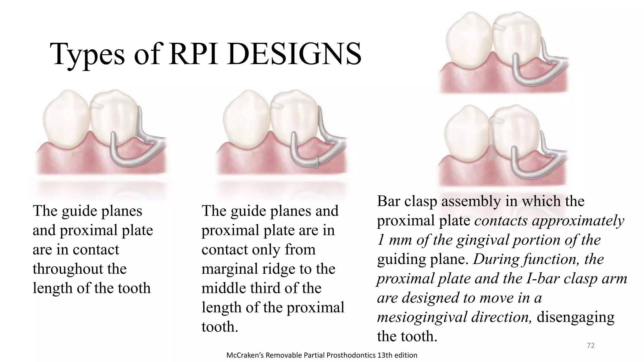Guide Plate In Rpd Principles of RPD designing | PPTX