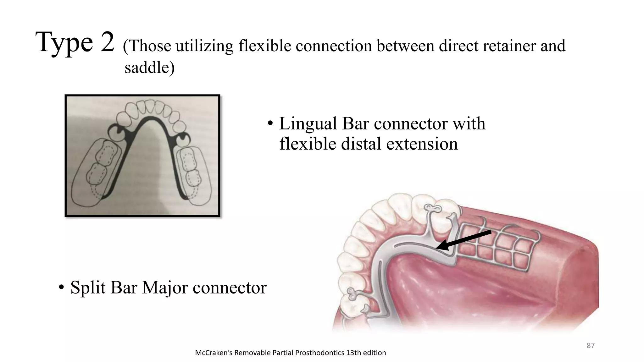 Principles of RPD designing | PPTX