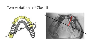 Class 2 Rpd Design Examples Principles of RPD designing | PPTX