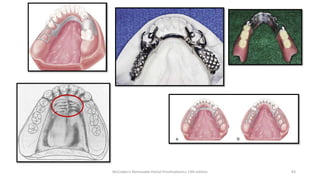 Lattice Rpd Principles of RPD designing | PPTX