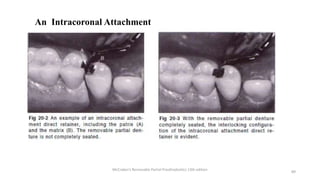 Internal Attachment Rpd Principles of RPD designing | PPTX