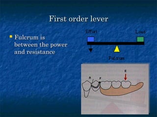 Lever System Rpd principles of rpd designing.ppt design consideration | PPT