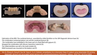 Comprehensive Principles and Design of Removable Partial Dentures (RPD ...