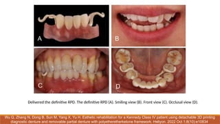 Comprehensive Principles and Design of Removable Partial Dentures (RPD ...