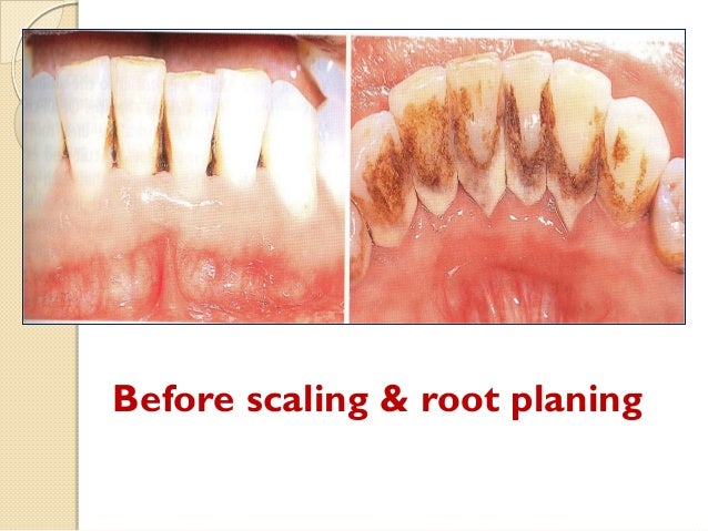 root planing