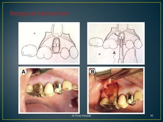 Simple Routine Extraction Principles of simple extractions 1 | PDF