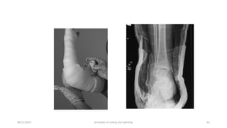 Principles of splints and casts (2).pptx