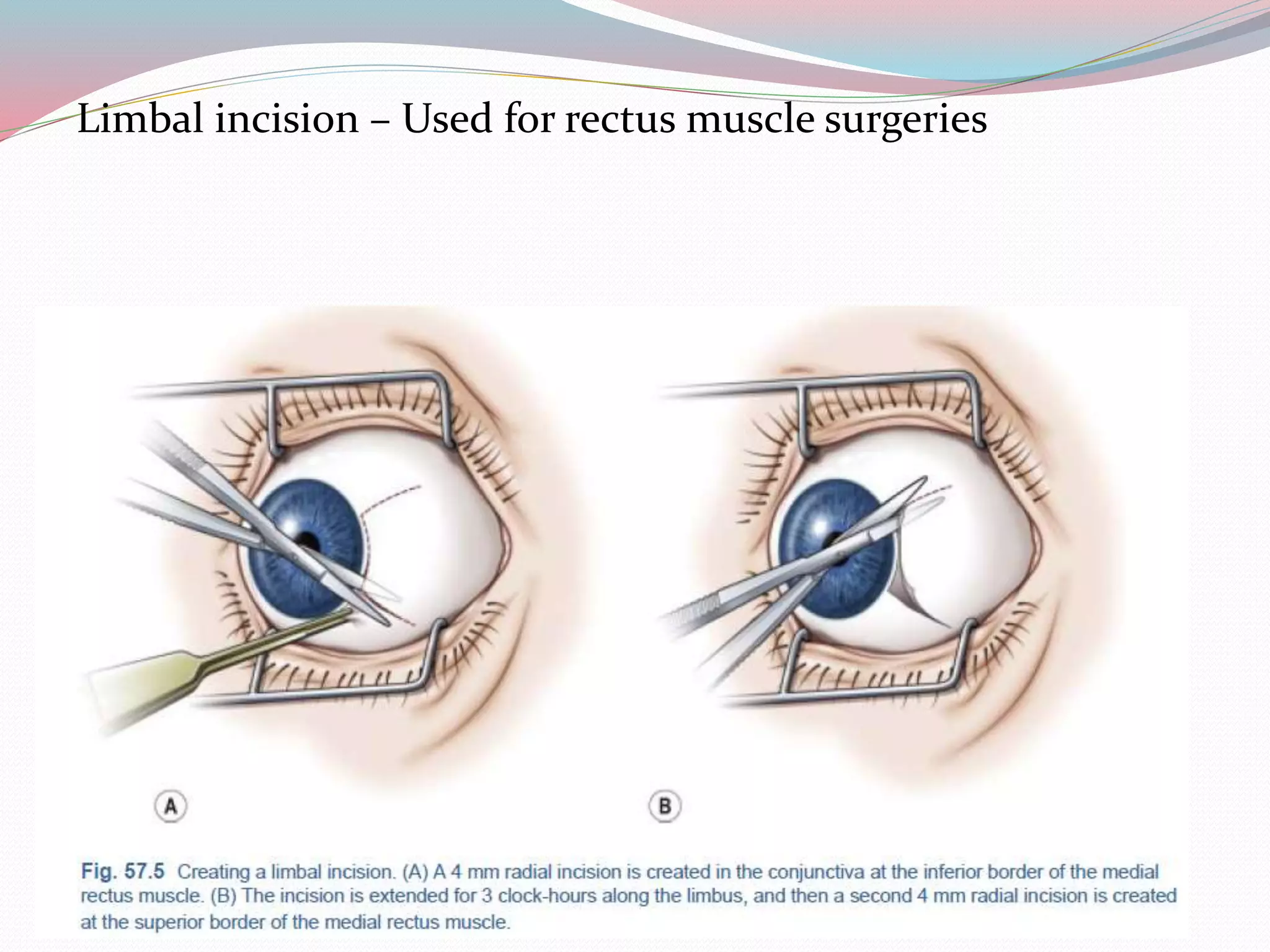 Limbal incision – Used for rectus muscle surgeries
 