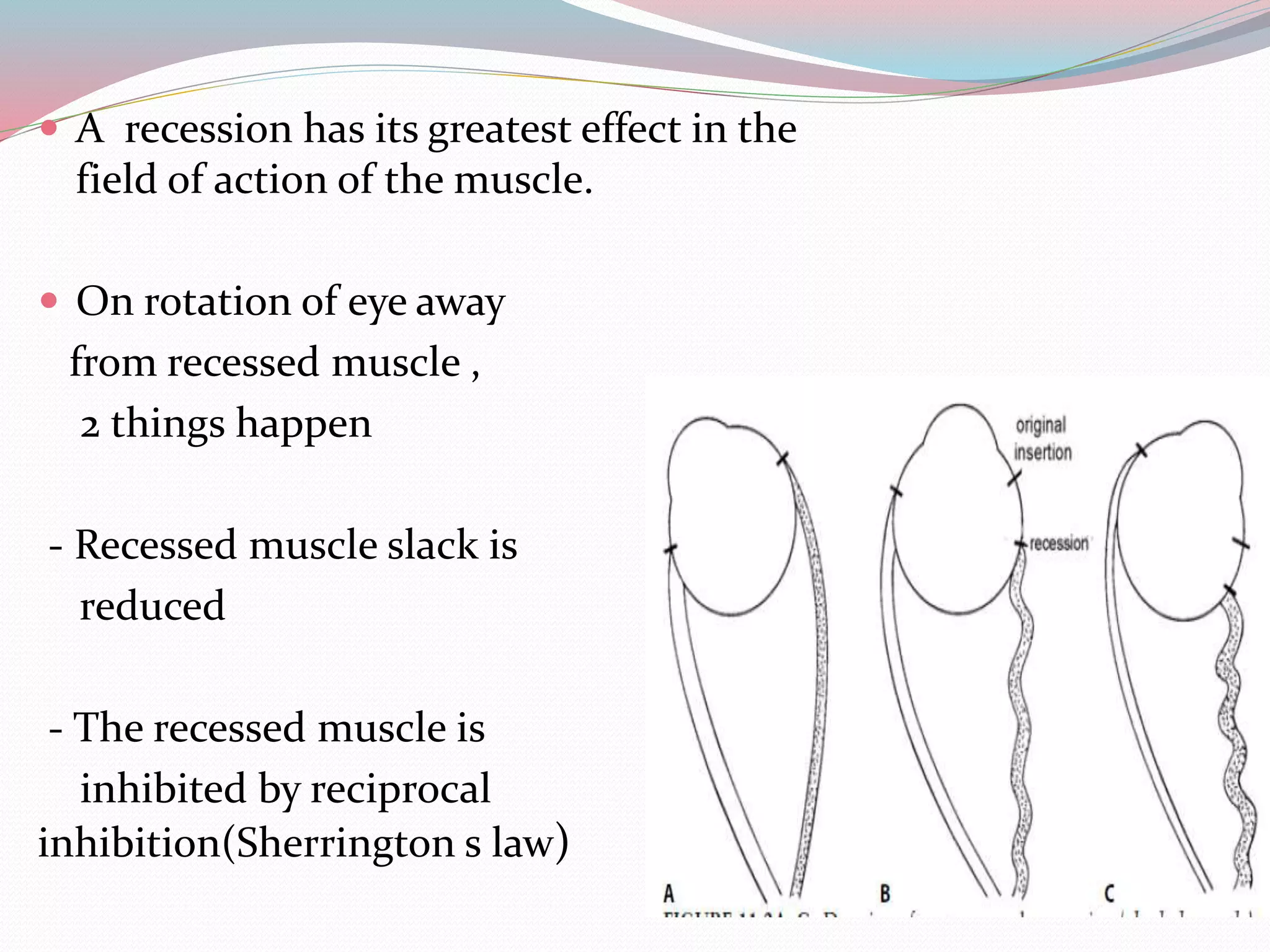  A recession has its greatest effect in the
field of action of the muscle.
 On rotation of eye away
from recessed muscle ,
2 things happen
- Recessed muscle slack is
reduced
- The recessed muscle is
inhibited by reciprocal
inhibition(Sherrington s law)
 