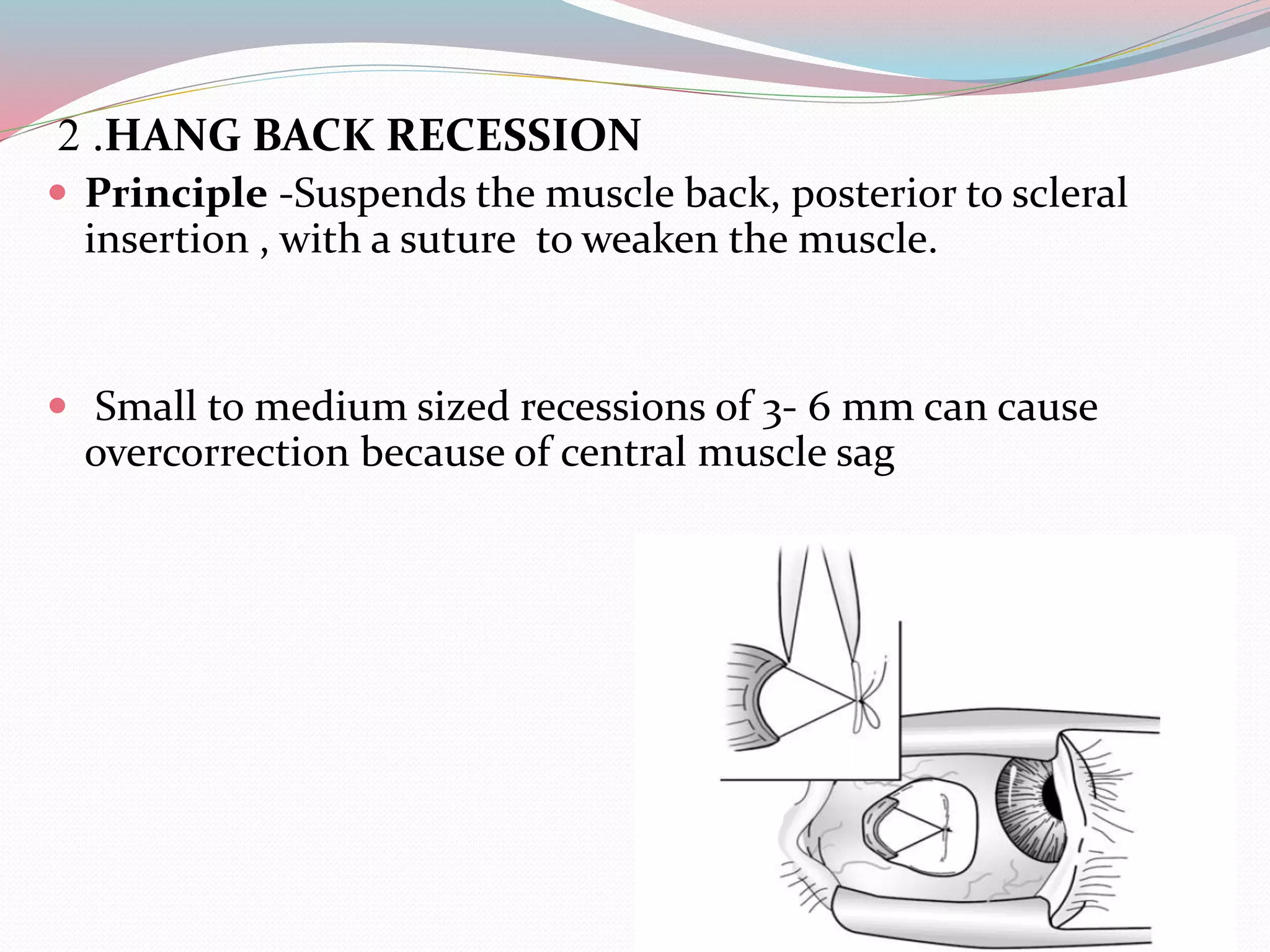 2 .HANG BACK RECESSION
 Principle -Suspends the muscle back, posterior to scleral
insertion , with a suture to weaken the muscle.
 Small to medium sized recessions of 3- 6 mm can cause
overcorrection because of central muscle sag
 