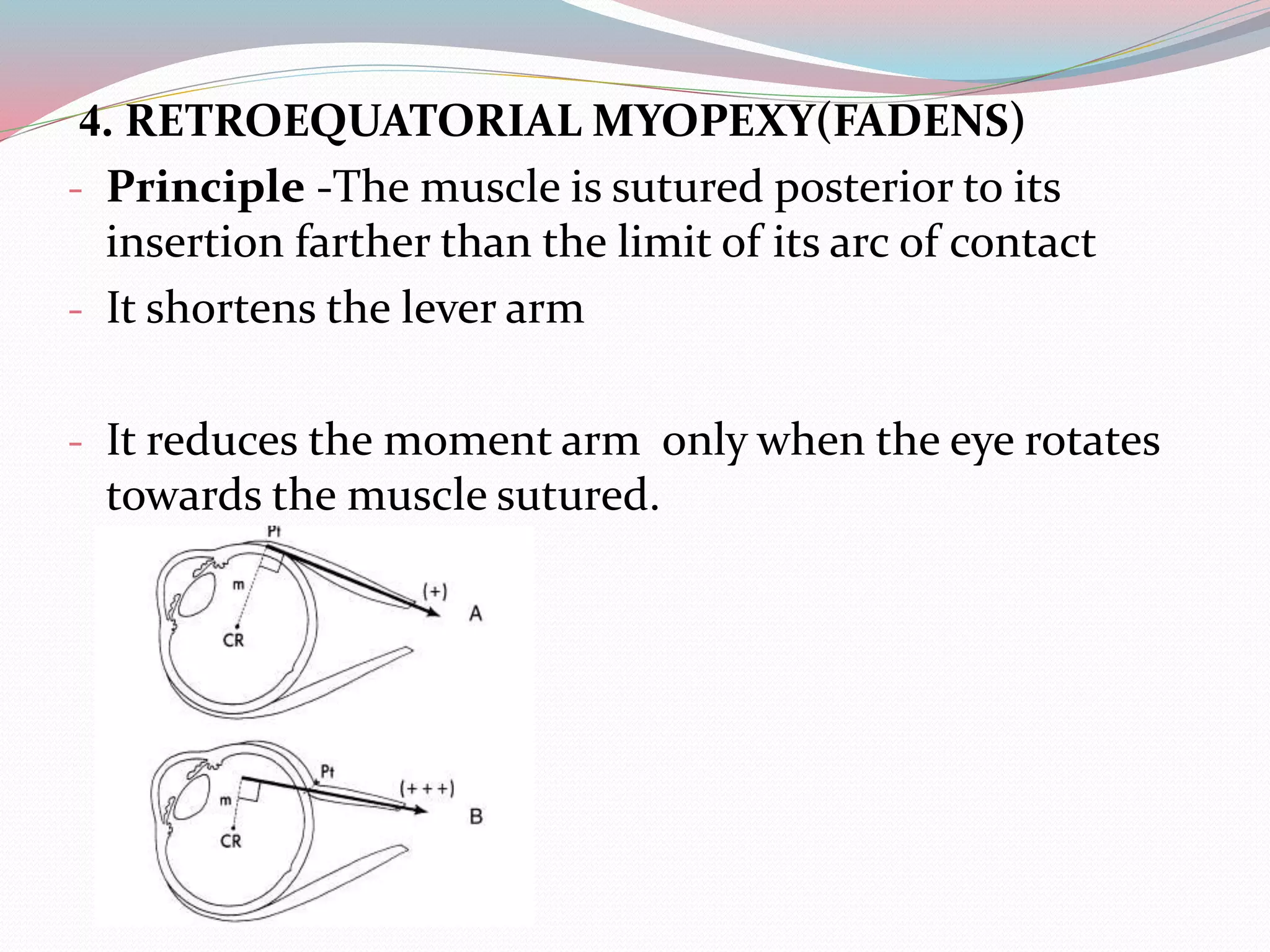 4. RETROEQUATORIAL MYOPEXY(FADENS)
- Principle -The muscle is sutured posterior to its
insertion farther than the limit of its arc of contact
- It shortens the lever arm
- It reduces the moment arm only when the eye rotates
towards the muscle sutured.
 