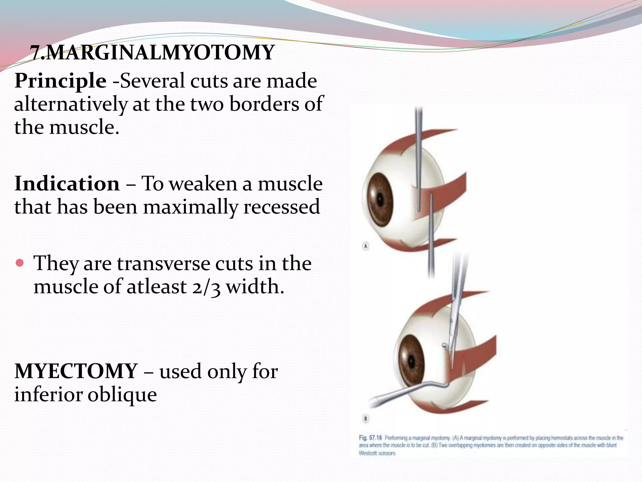 7.MARGINALMYOTOMY
Principle -Several cuts are made
alternatively at the two borders of
the muscle.
Indication – To weaken a muscle
that has been maximally recessed
 They are transverse cuts in the
muscle of atleast 2/3 width.
MYECTOMY – used only for
inferior oblique
 
