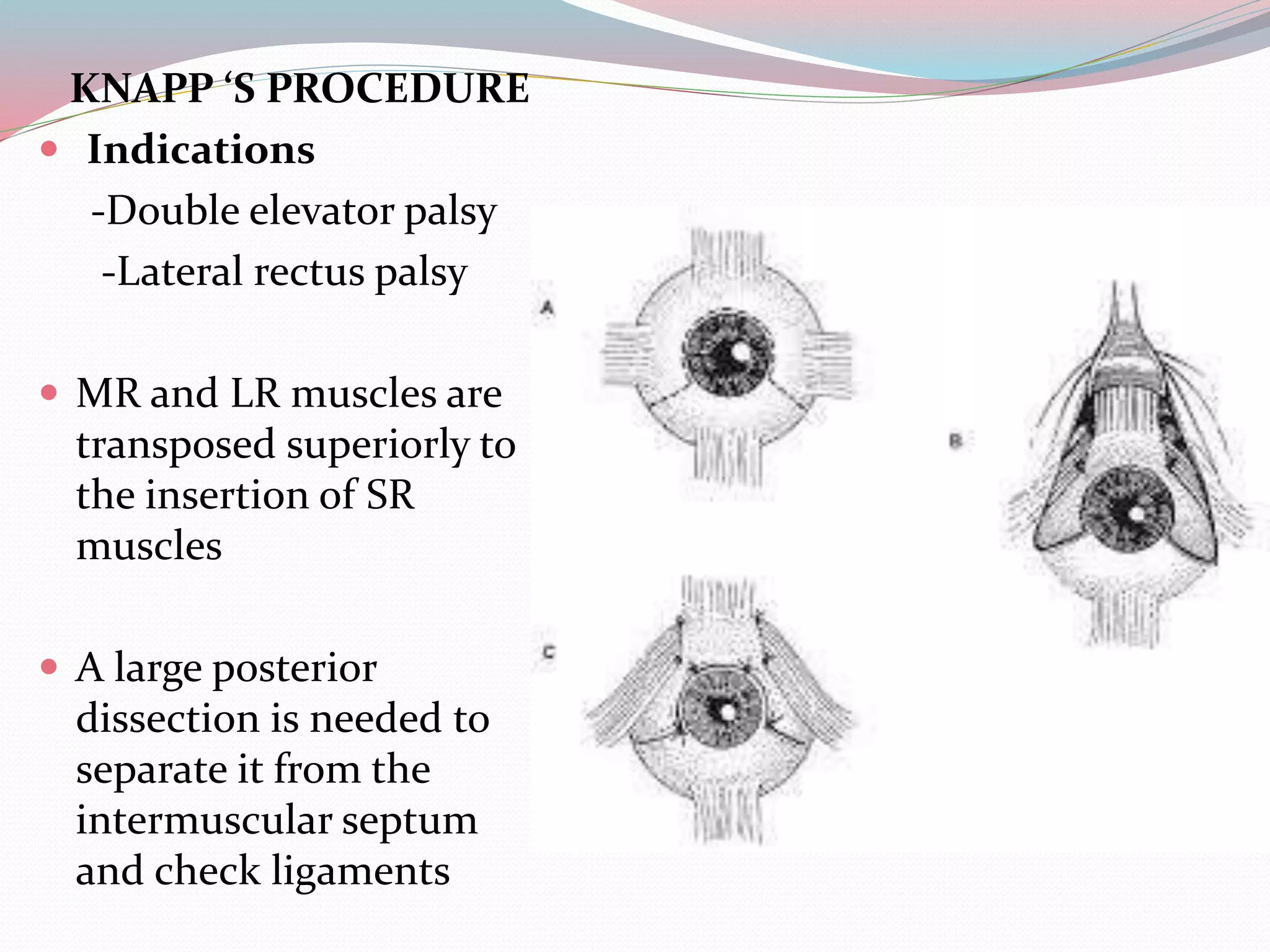 KNAPP ‘S PROCEDURE
 Indications
-Double elevator palsy
-Lateral rectus palsy
 MR and LR muscles are
transposed superiorly to
the insertion of SR
muscles
 A large posterior
dissection is needed to
separate it from the
intermuscular septum
and check ligaments
 