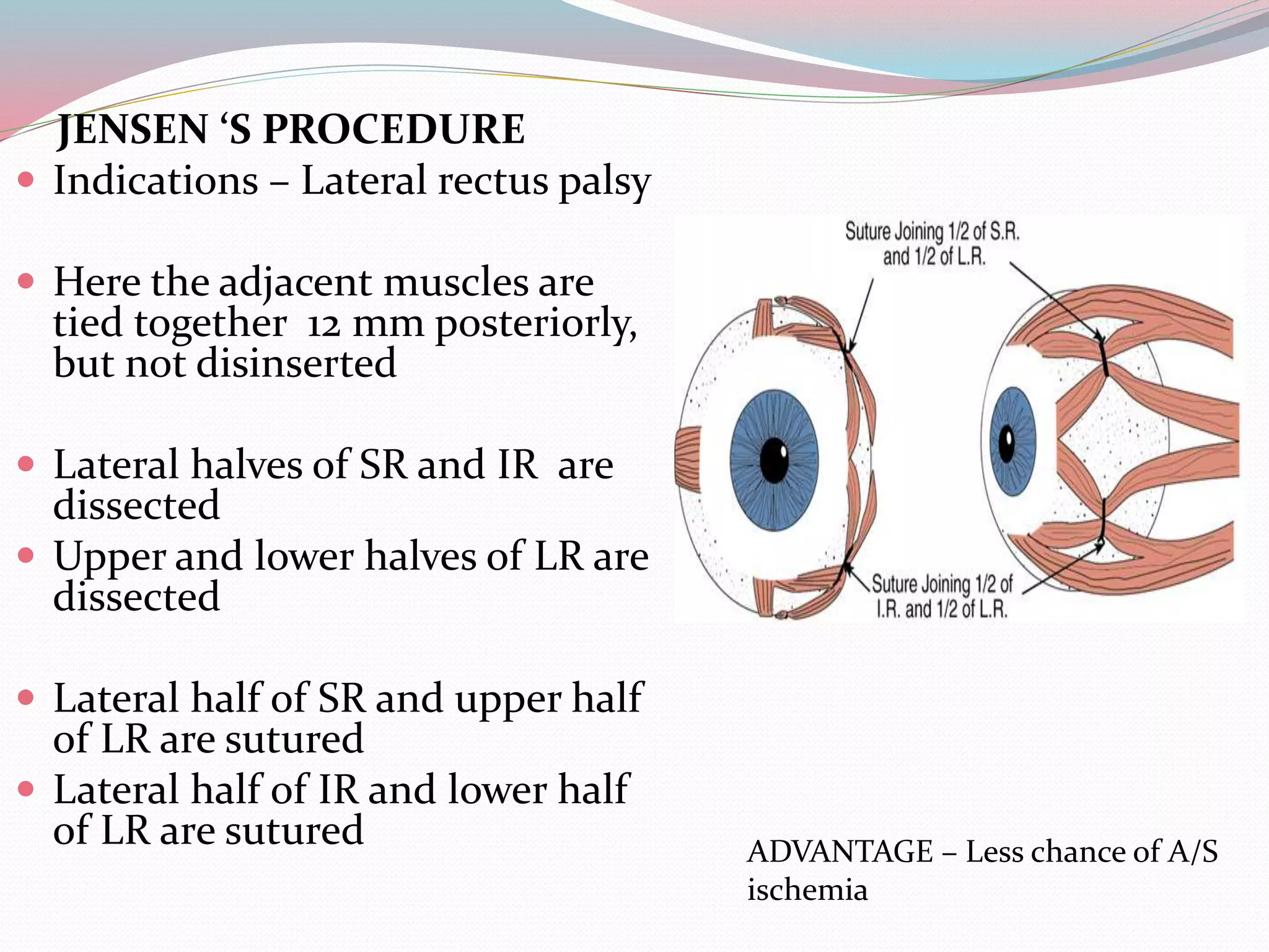 JENSEN ‘S PROCEDURE
 Indications – Lateral rectus palsy
 Here the adjacent muscles are
tied together 12 mm posteriorly,
but not disinserted
 Lateral halves of SR and IR are
dissected
 Upper and lower halves of LR are
dissected
 Lateral half of SR and upper half
of LR are sutured
 Lateral half of IR and lower half
of LR are sutured ADVANTAGE – Less chance of A/S
ischemia
 
