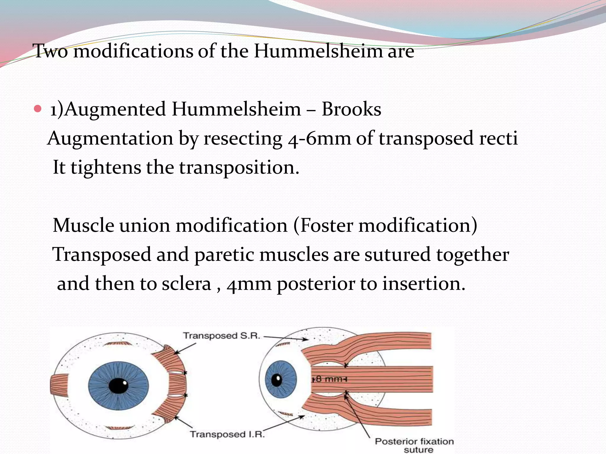 Two modifications of the Hummelsheim are
 1)Augmented Hummelsheim – Brooks
Augmentation by resecting 4-6mm of transposed recti
It tightens the transposition.
Muscle union modification (Foster modification)
Transposed and paretic muscles are sutured together
and then to sclera , 4mm posterior to insertion.
 