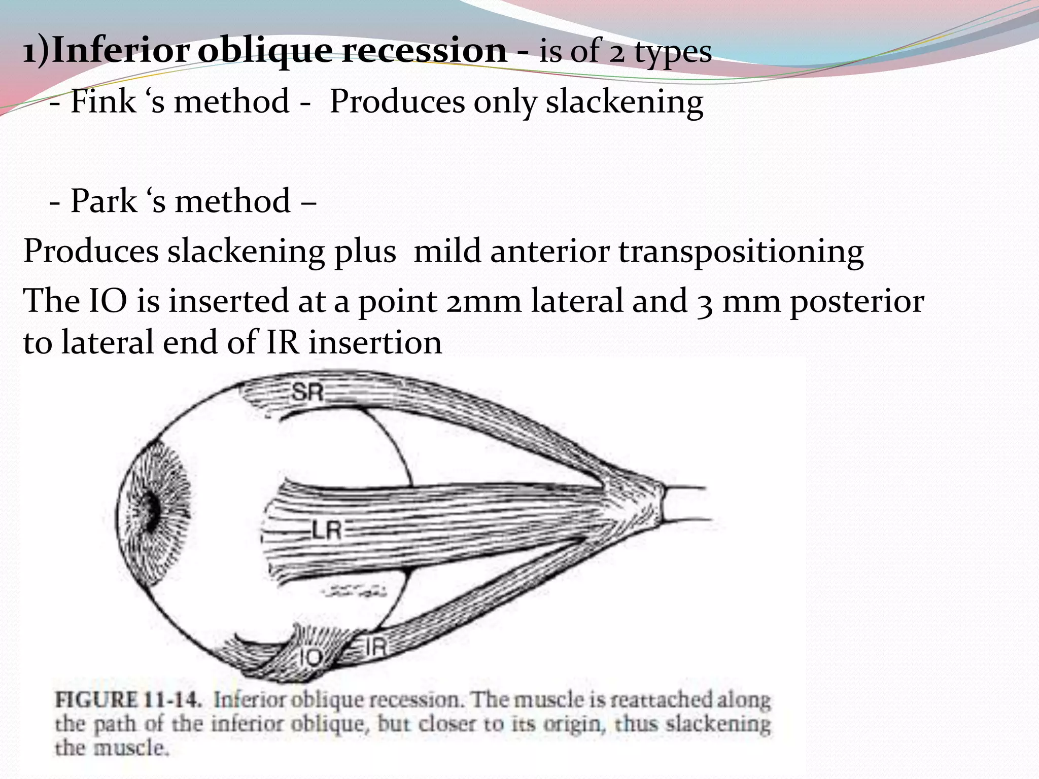 1)Inferior oblique recession - is of 2 types
- Fink ‘s method - Produces only slackening
- Park ‘s method –
Produces slackening plus mild anterior transpositioning
The IO is inserted at a point 2mm lateral and 3 mm posterior
to lateral end of IR insertion
 
