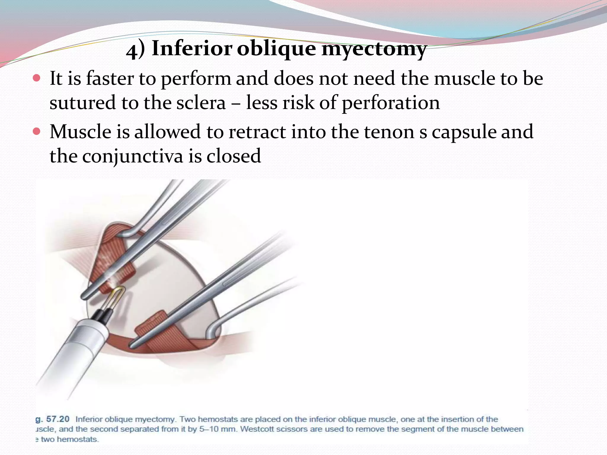 4) Inferior oblique myectomy
 It is faster to perform and does not need the muscle to be
sutured to the sclera – less risk of perforation
 Muscle is allowed to retract into the tenon s capsule and
the conjunctiva is closed
 
