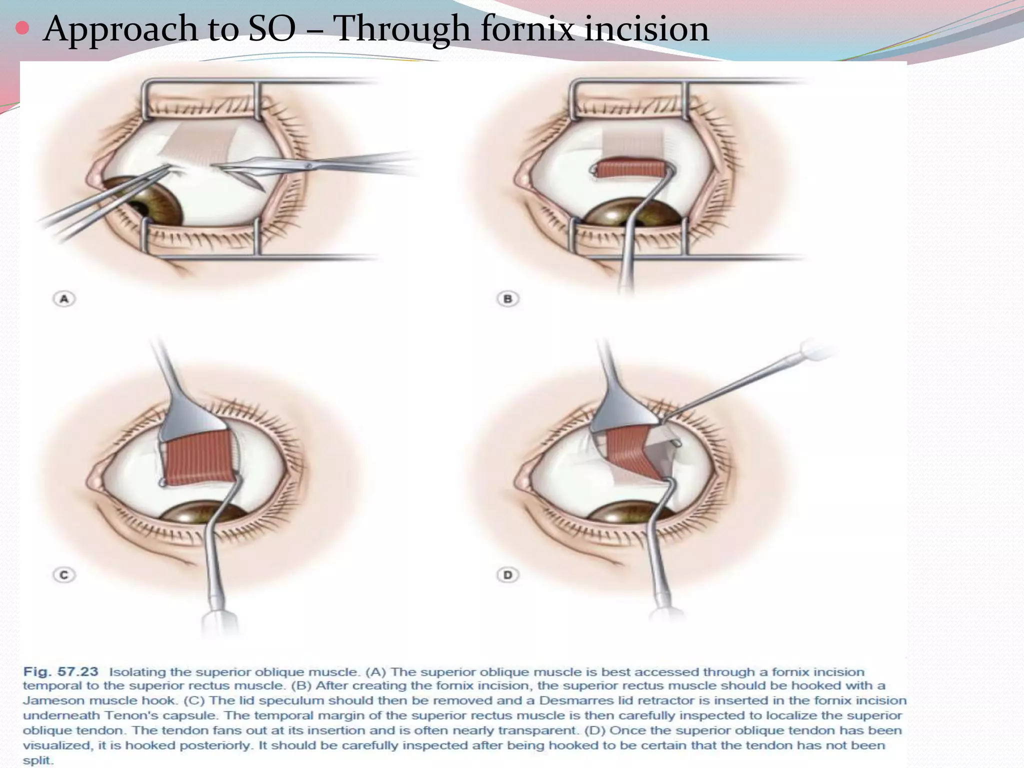  Approach to SO – Through fornix incision
 