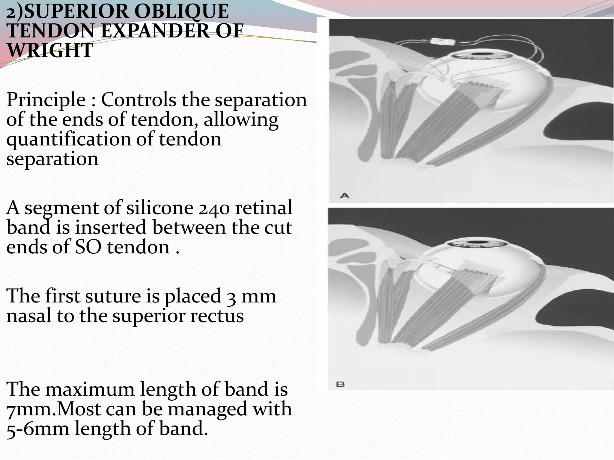 2)SUPERIOR OBLIQUE
TENDON EXPANDER OF
WRIGHT
Principle : Controls the separation
of the ends of tendon, allowing
quantification of tendon
separation
A segment of silicone 240 retinal
band is inserted between the cut
ends of SO tendon .
The first suture is placed 3 mm
nasal to the superior rectus
The maximum length of band is
7mm.Most can be managed with
5-6mm length of band.
 