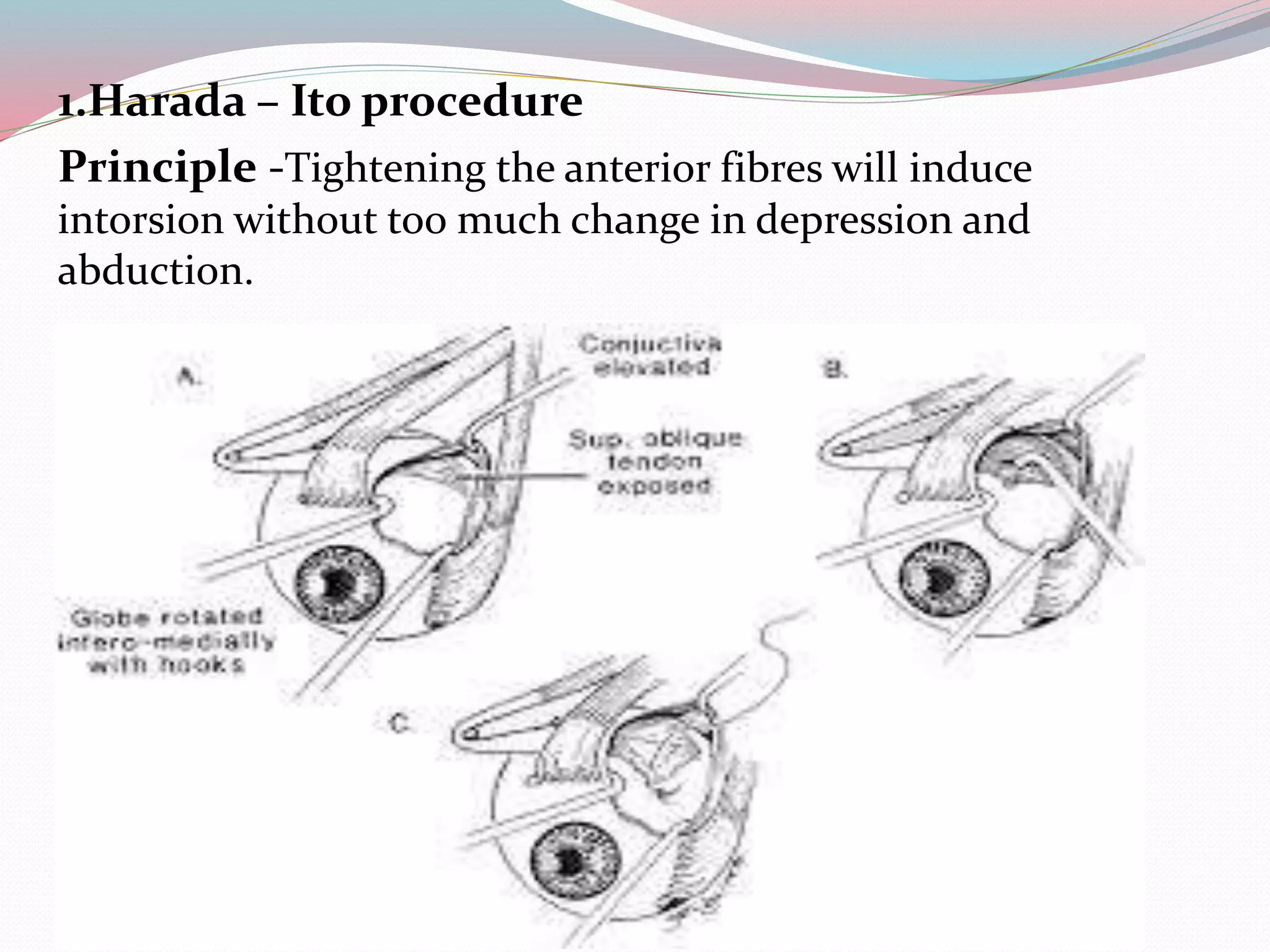 1.Harada – Ito procedure
Principle -Tightening the anterior fibres will induce
intorsion without too much change in depression and
abduction.
 
