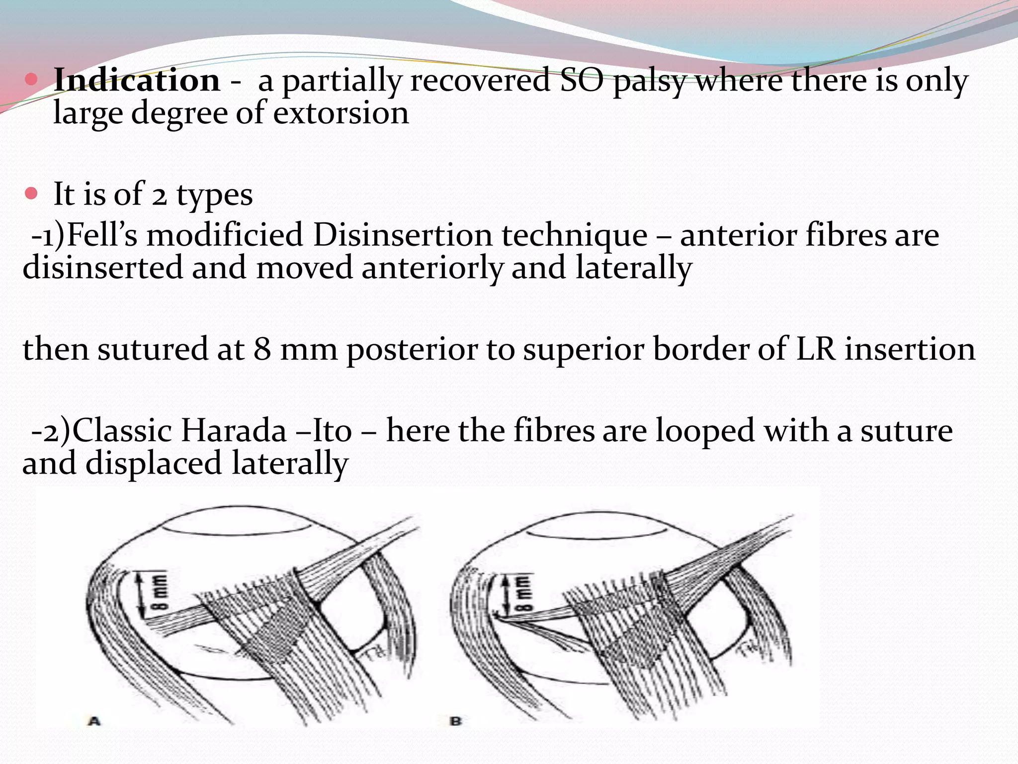  Indication - a partially recovered SO palsy where there is only
large degree of extorsion
 It is of 2 types
-1)Fell’s modificied Disinsertion technique – anterior fibres are
disinserted and moved anteriorly and laterally
then sutured at 8 mm posterior to superior border of LR insertion
-2)Classic Harada –Ito – here the fibres are looped with a suture
and displaced laterally
 