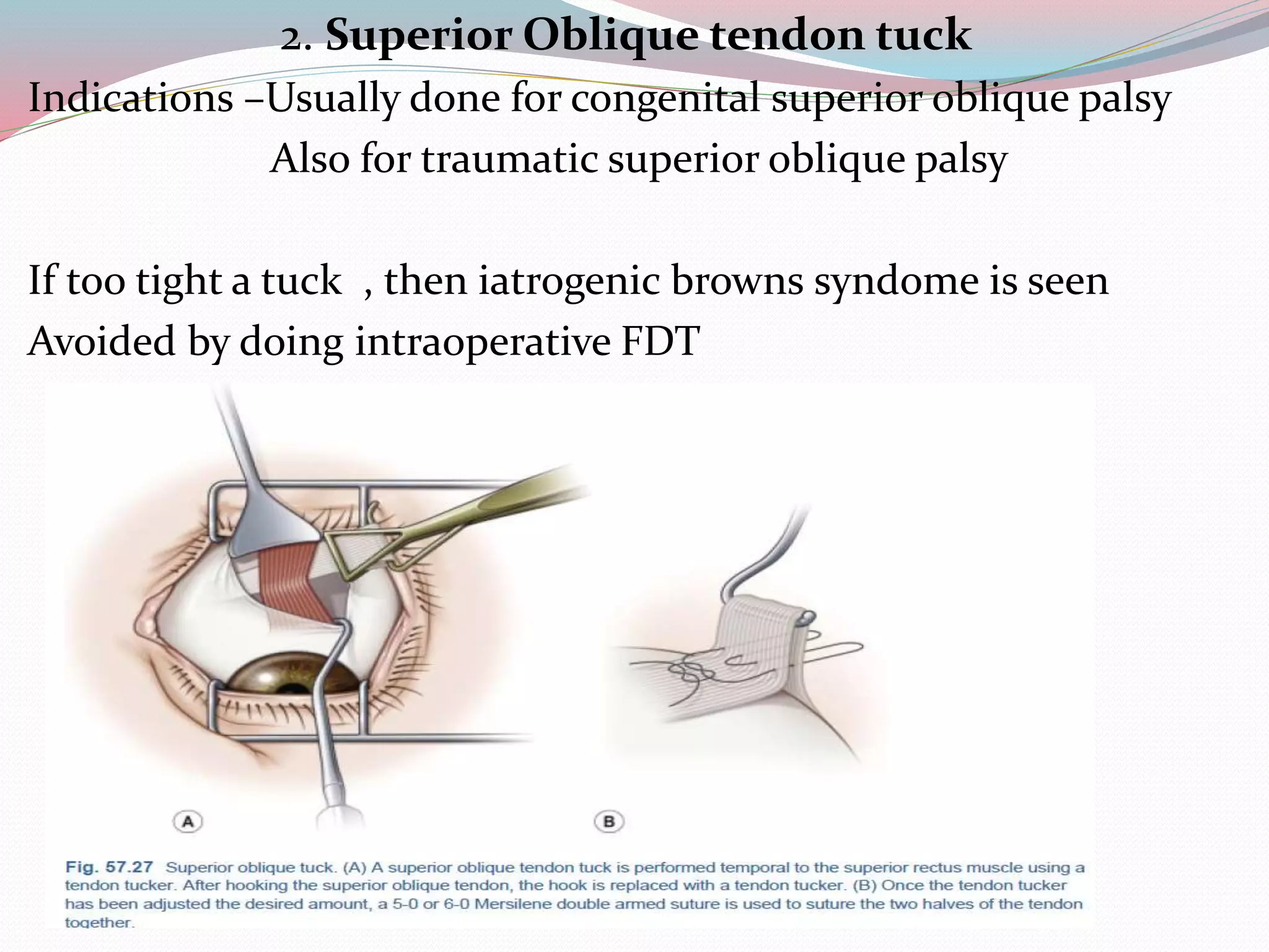 2. Superior Oblique tendon tuck
Indications –Usually done for congenital superior oblique palsy
Also for traumatic superior oblique palsy
If too tight a tuck , then iatrogenic browns syndome is seen
Avoided by doing intraoperative FDT
 
