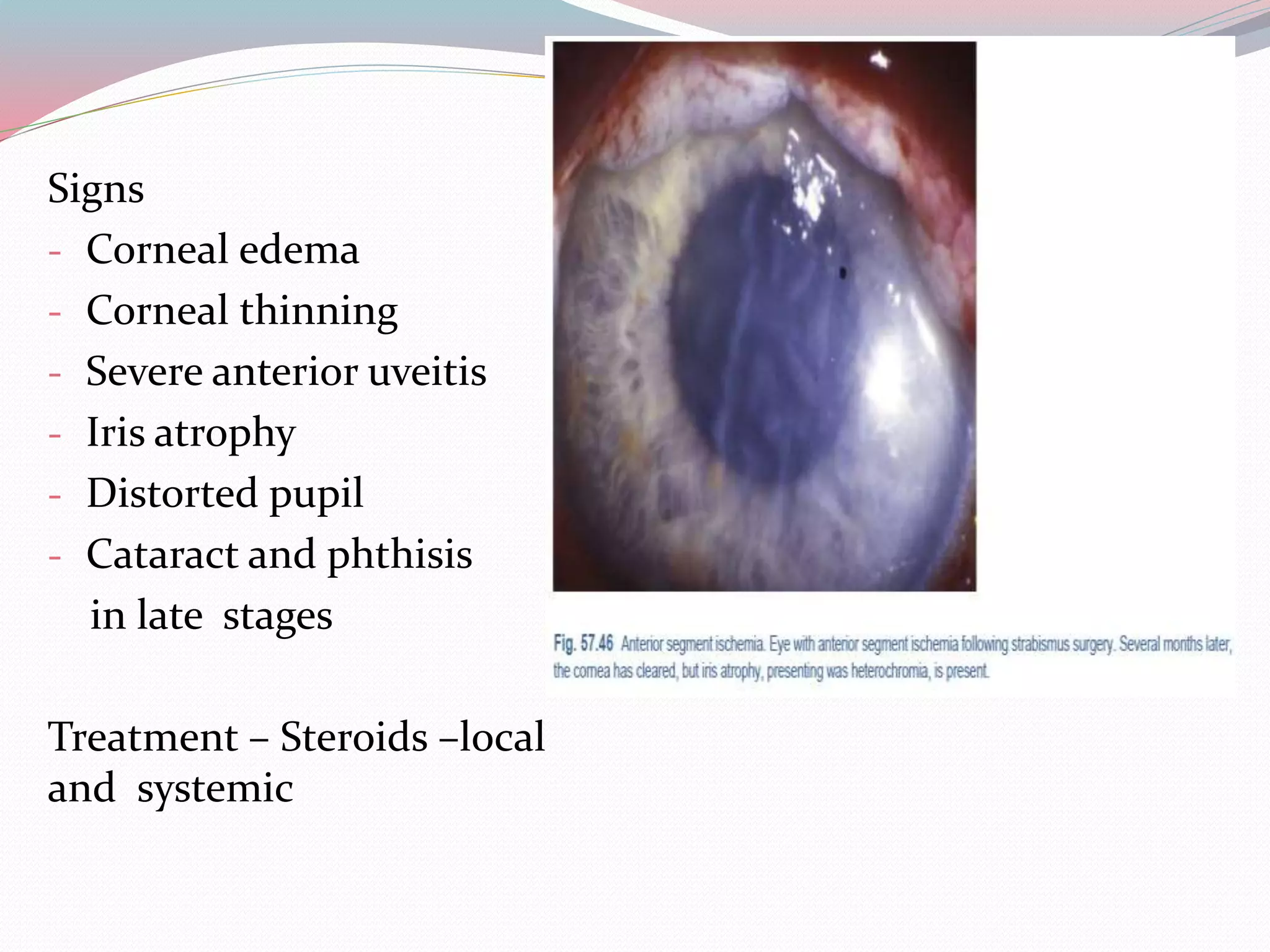 Signs
- Corneal edema
- Corneal thinning
- Severe anterior uveitis
- Iris atrophy
- Distorted pupil
- Cataract and phthisis
in late stages
Treatment – Steroids –local
and systemic
 