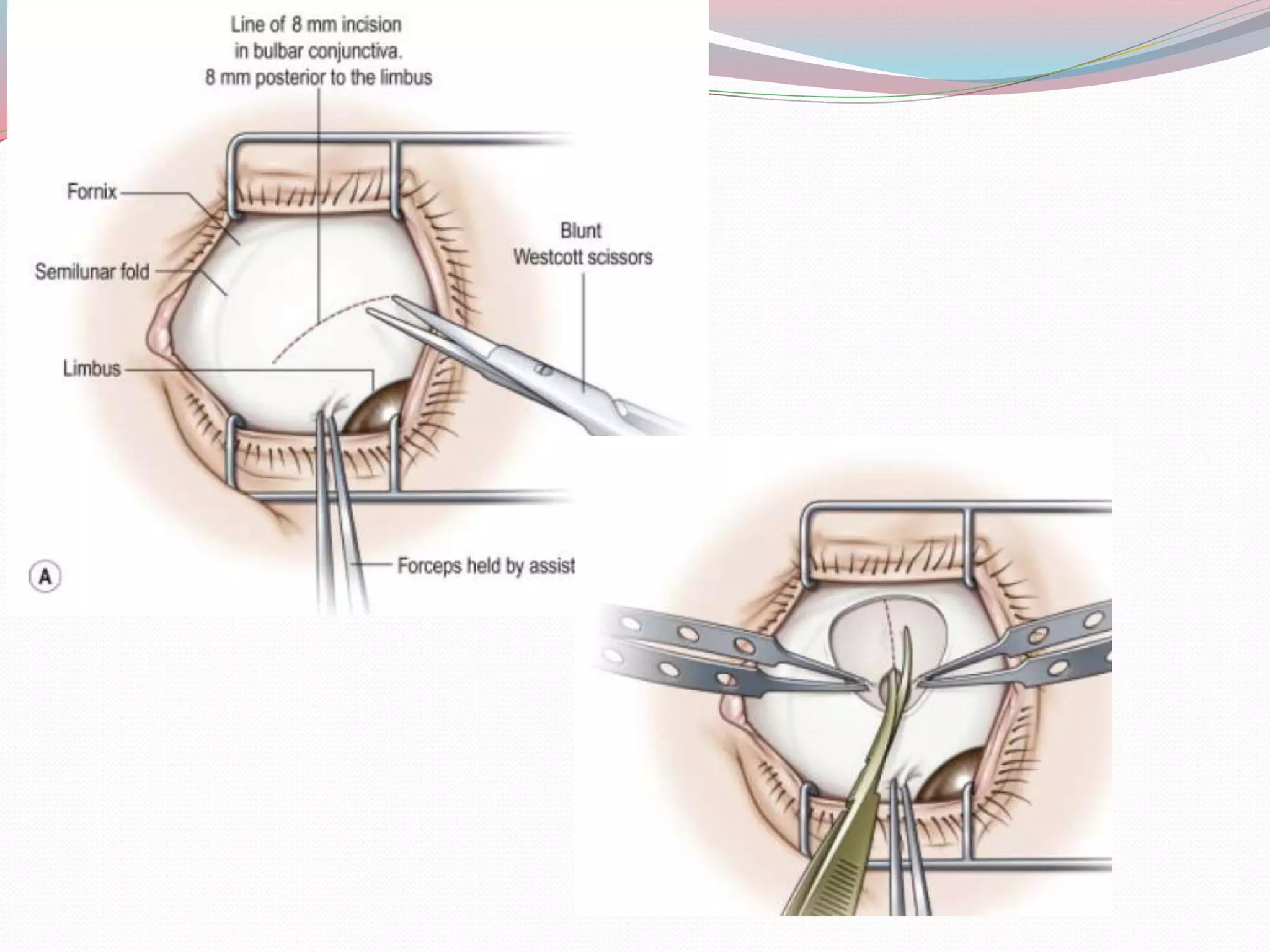 principles-of-strabismus-surgery-pptx