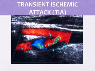 TRANSIENT ISCHEMIC
ATTACK (TIA)
 