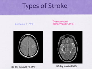 Types of Stroke
Ischemic (~74%)
Intracerebral
hemorrhage(~24%)
30 day survival 73-81% 30 day survival 36%
 