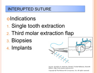 INTERUPTED SUTURE
Indications
1. Single tooth extraction
2. Third molar extraction flap
3. Biopsies
4. Implants
 