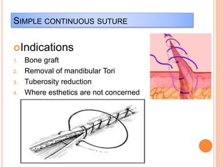 SIMPLE CONTINUOUS SUTURE
Indications
1. Bone graft
2. Removal of mandibular Tori
3. Tuberosity reduction
4. Where esthetics are not concerned
 