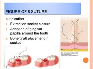FIGURE OF 8 SUTURE
 Indication
1. Extraction socket closure
2. Adaption of gingival
papilla around the tooth
3. Bone graft placement in
socket
 