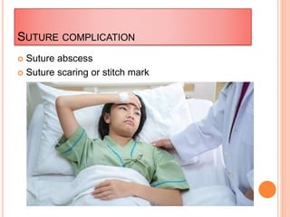 SUTURE COMPLICATION
 Suture abscess
 Suture scaring or stitch mark
 