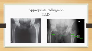 Ledge Radiograph Principles Of Total Hip Replacement | PPTX