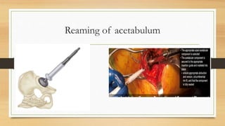 Principles Of Total Hip Replacement | PPTX