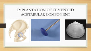 Principles Of Total Hip Replacement | PPTX